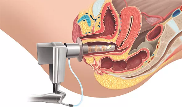 atrophie-vaginale-laser (1)