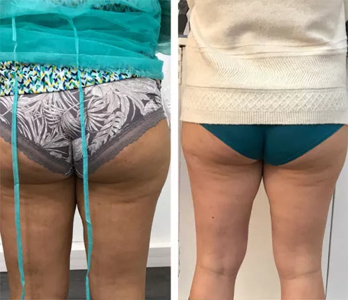 cryolipolyse-cristal-avant-apres-cuisses-500×432