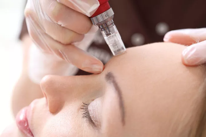 microneedling–700×467