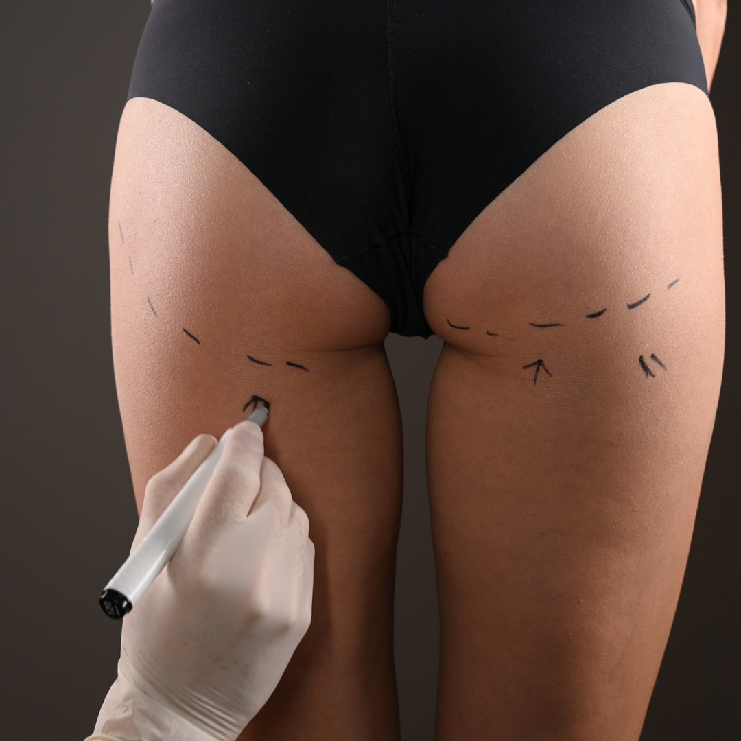 IMPLANTS-FESSIER