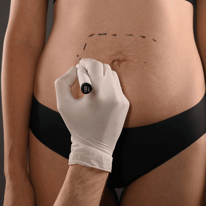 abdominoplatie (1)