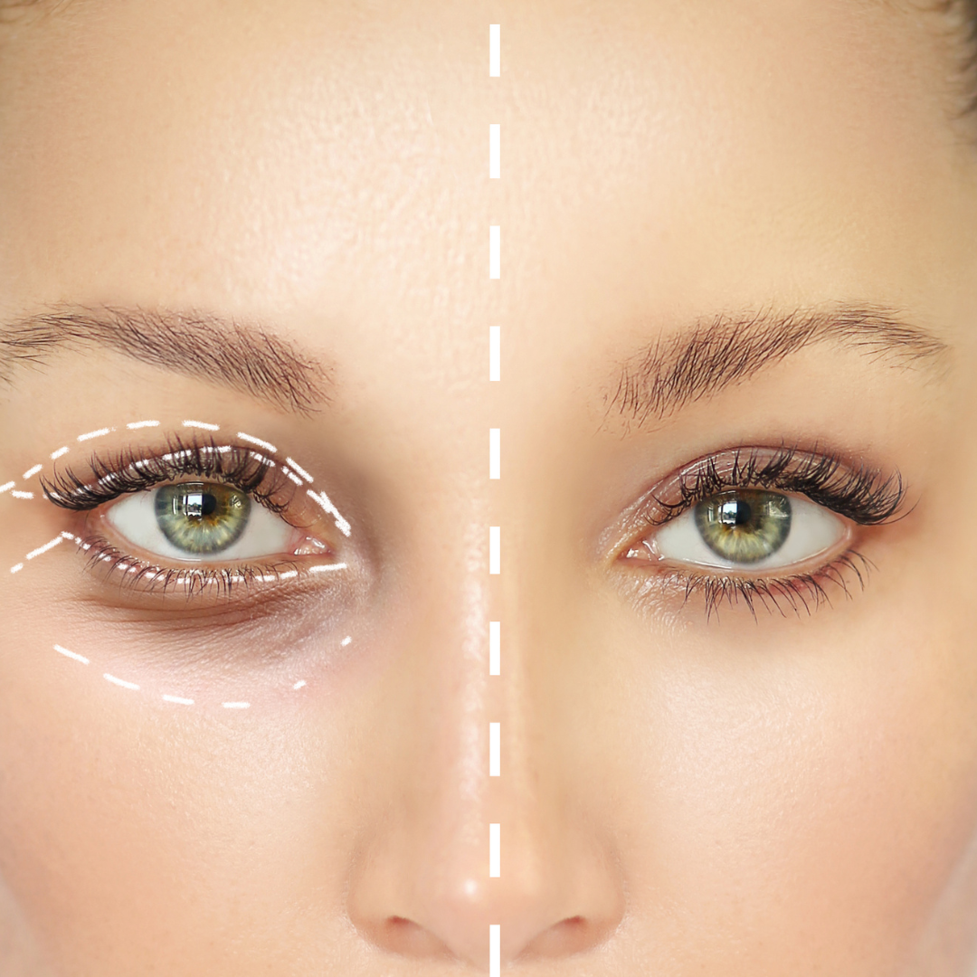 blépharoplastie