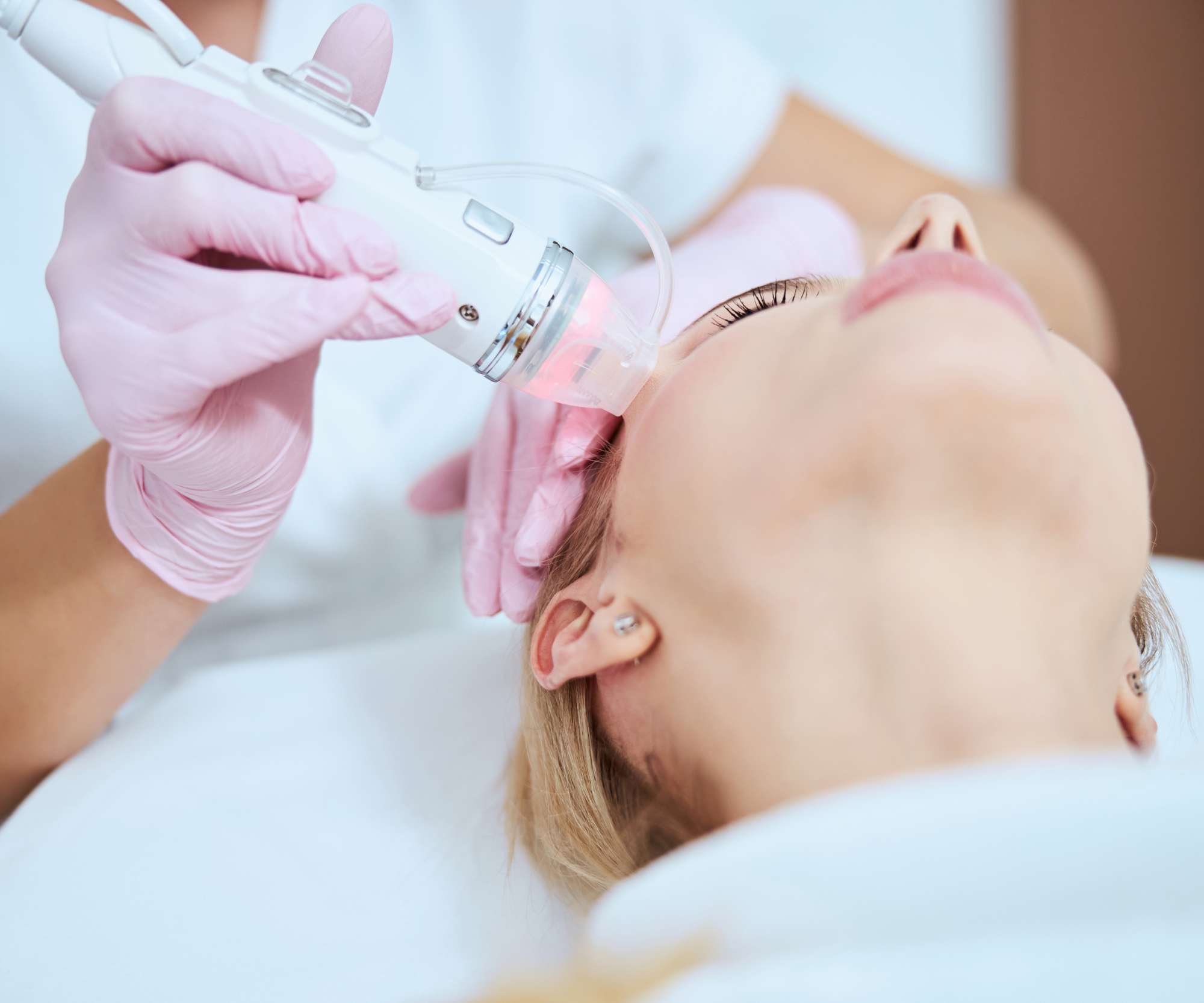 Microneedling
